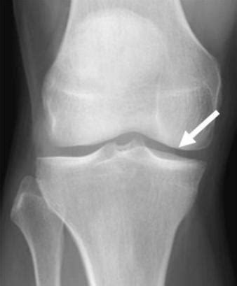 Knee Arthritis Treatment | DR. RAJ KANNA Knee clinic, Chennai