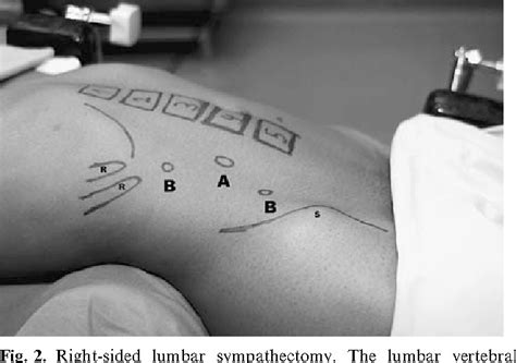 RLS may be safe and effective surgical treatment for severe ...