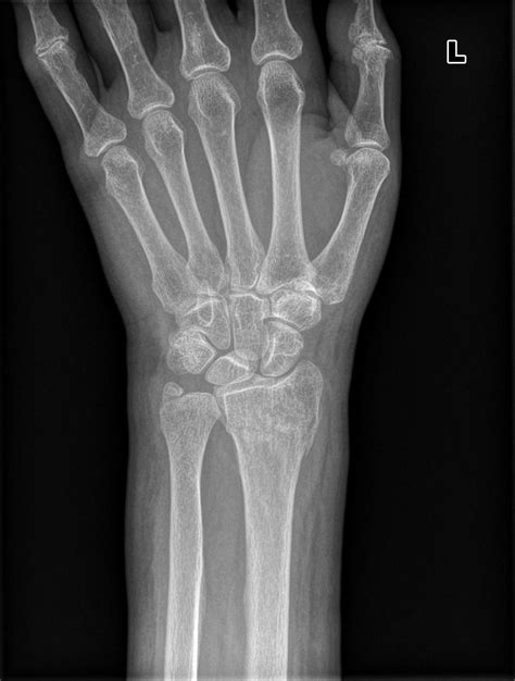 Image result for Simple Radius Fracture