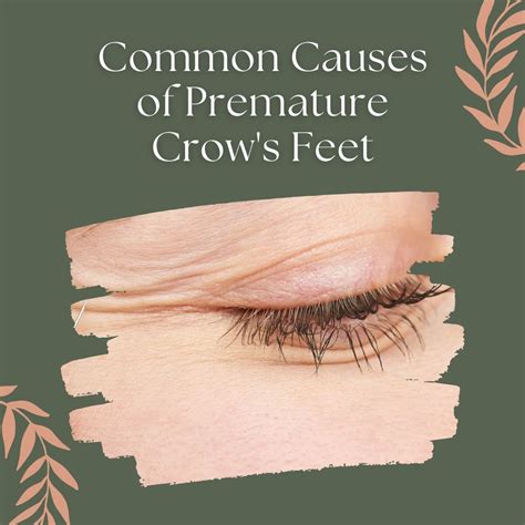 Common causes of crow's feet | Crows feet, Skincare habits, Skincare