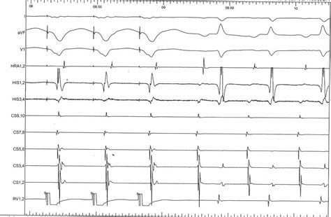 Supraventricular Tachycardia
