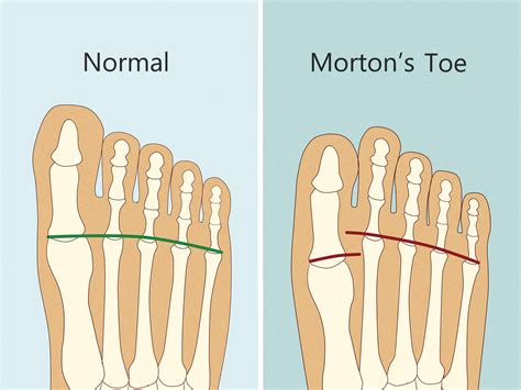 Does Losing Your Big Toe Affect Your Balance