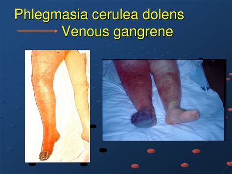 PPT - DEEP VENOUS THROMBOSIS PowerPoint Presentation, free download ...