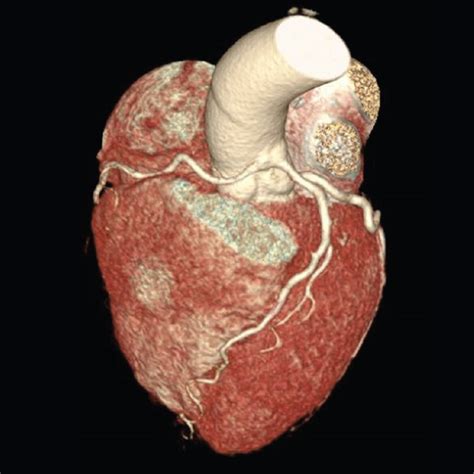 Fatal Coronary Artery Anomaly in a Young Athlete Presenting as Syncope