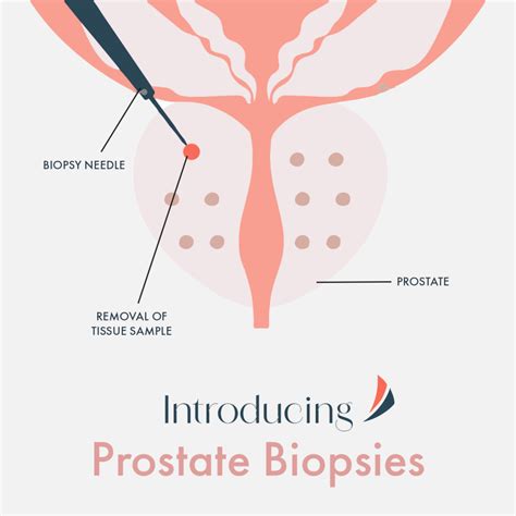 Introducing Prostate Biopsies! – MIC Radiology Group