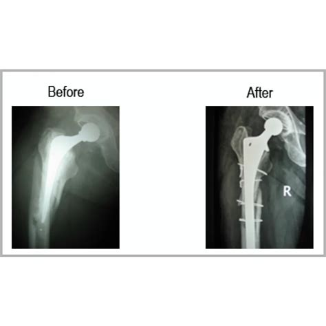 Total Hip Implant In Place With Fracture Femur - Dr Samir Nanavati