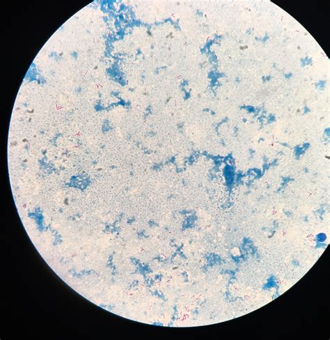 Mycobacterium tuberculosis (Ziehl–Neelsen stain). : r/MicroPorn