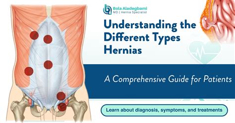 Understanding the Different Types of Hernias: A Comprehensive Guide for ...
