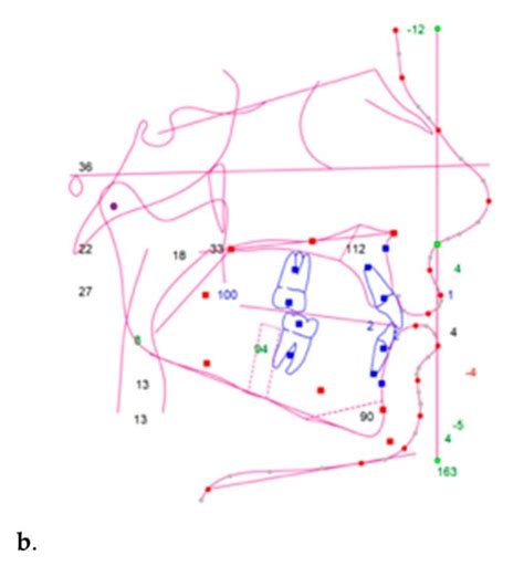 Intermolar Mandibular Distraction Osteogenesis—A Preliminary Report