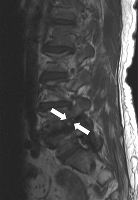 A Practical MRI Grading System for Lumbar Foraminal Stenosis | AJR