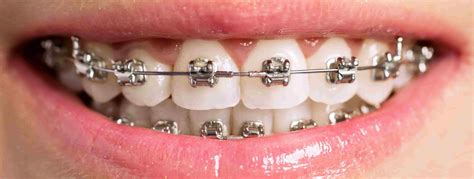 Metal Teeth Braces