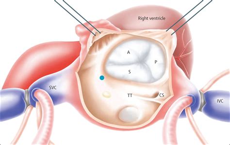 Tricuspid Valve