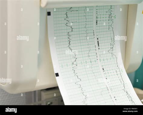 Monitor for measuring contractions, heartbeat of a pregnant woman Stock Photo - Alamy