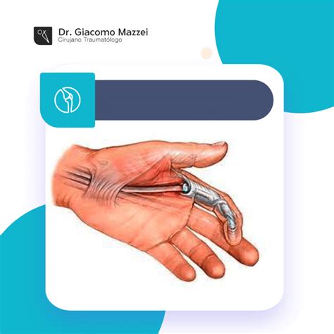 Síndrome del túnel carpiano: Causas y prevención | Dr Giacomo Mazzei