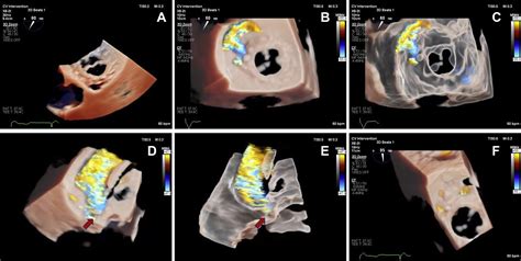 Image result for Transillumination