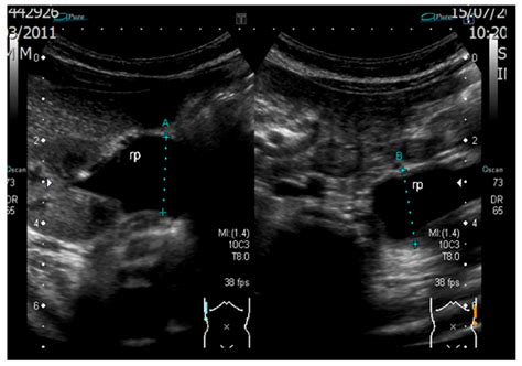 Prenatal Diagnosis of Severe Fetal Hydronephrosis Due to Pyeloureteral ...