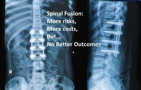 When Is Spinal Fusion Necessary