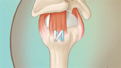 Image result for Rotator Cuff Repair Photo
