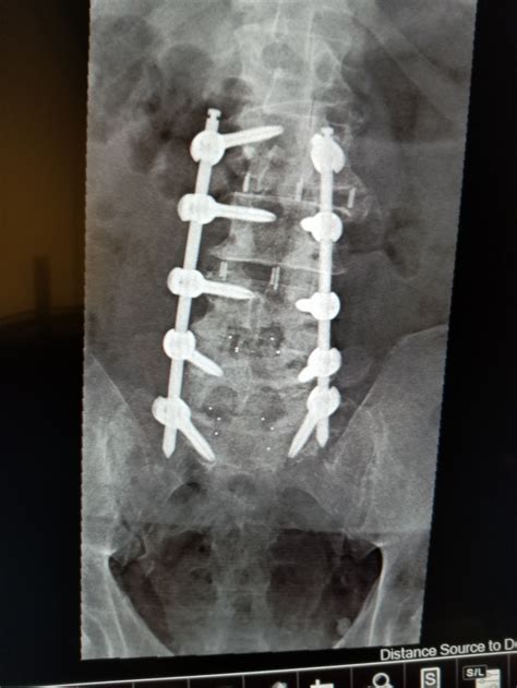 Now I Better Understand Why Spinal Fusion Recovery Is So Painful – Feathered Photography