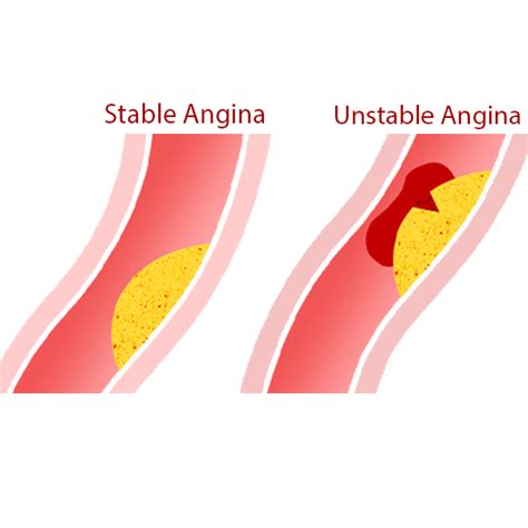 What medical treatment should be given to a patient with stable and ...