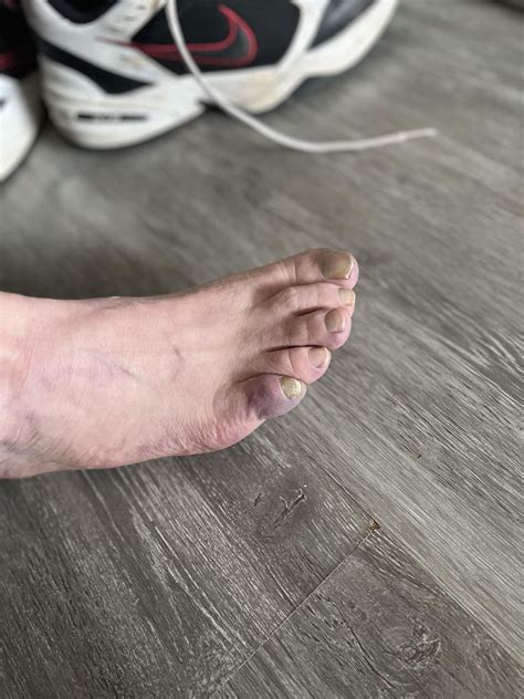 FIL (60m) pinky toes (both feet) look like this. He says they’re very ...