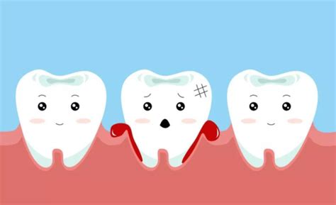 刷牙牙龈老是出血是什么原因？ - 知乎