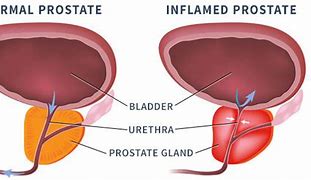 Image result for Prostatitis