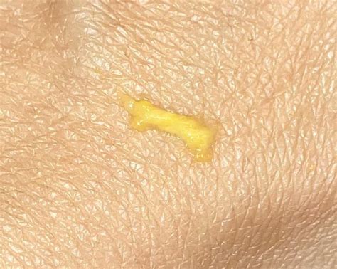 1st time bright yellow discharge (see pic)…no odor, no pain, and no ...