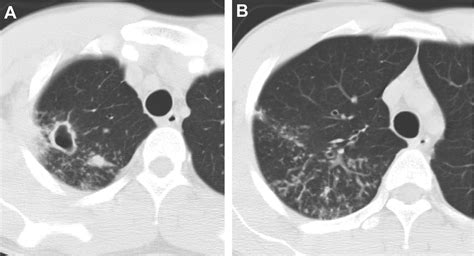 Cavitary Lesion Of Lung