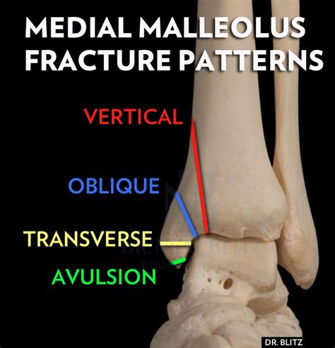 5 Kinds of Medial Malleolus Ankle Fractures