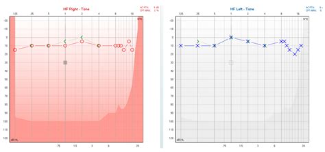 Diagnosis and Assessment of Chronic Imbalance due to Saccular ...