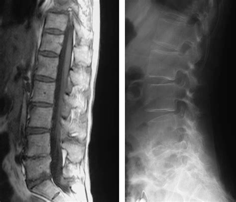 Radiological features of lumbar spinal lesions in patients with rheumatoid arthritis with ...