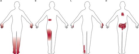 Diabetic Foot Neuropathy