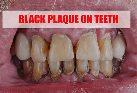 Image result for Stumpy Black Teeth