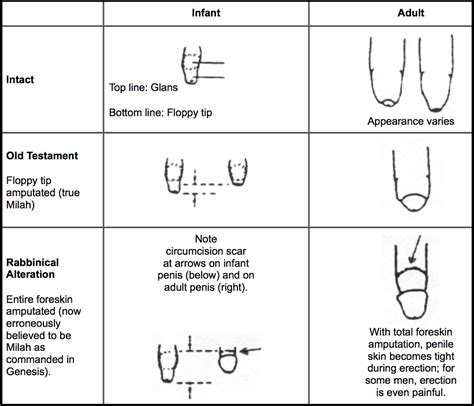 Exploring The Different Circumcision Cuts: A Comprehensive Guide