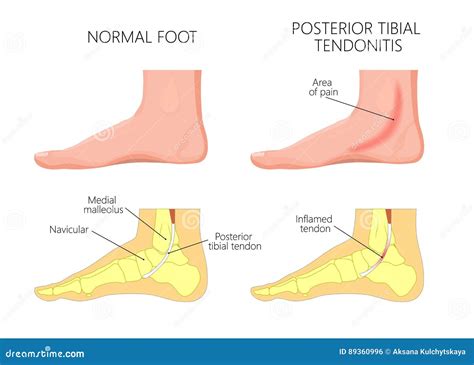 Foot Joint Tendonitis at Gene Courtney blog
