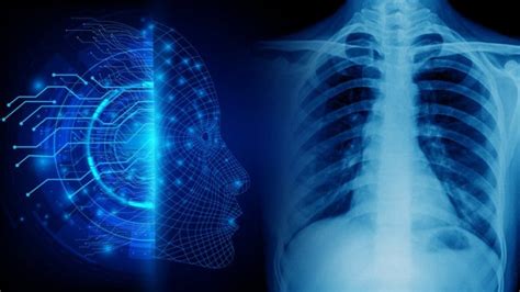 Based On Chest X-Ray Data, AI Can Predict Long-Term Mortality ...
