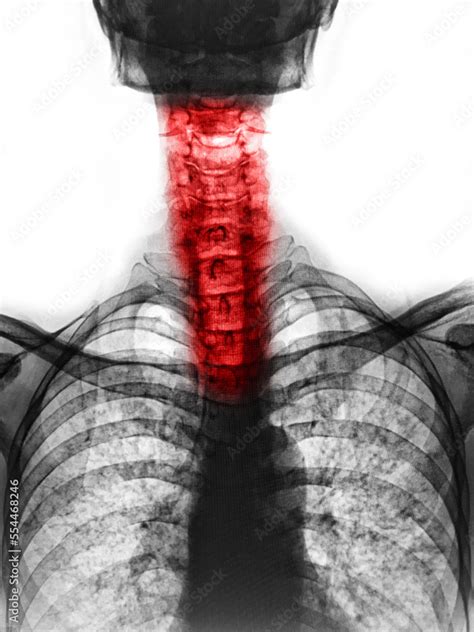 film x-ray skull lateral view and neck pain Stock Photo | Adobe Stock