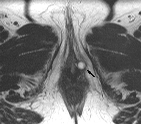 Skenes Glands Diagram