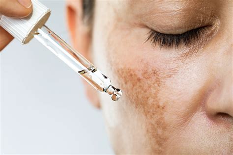 Chemical Peels for Darker Complexions: A Dermatologist’s Guide