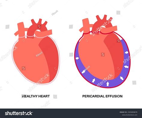 Cardiac Tamponade In The Heart