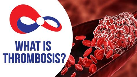 World Thrombosis Day 2021 : Thrombosis, Symptoms, Treatment Explained ...