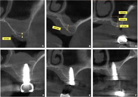 Fluid-Dynamic Crestal Sinus Floor Elevation in Atrophic Posterior ...