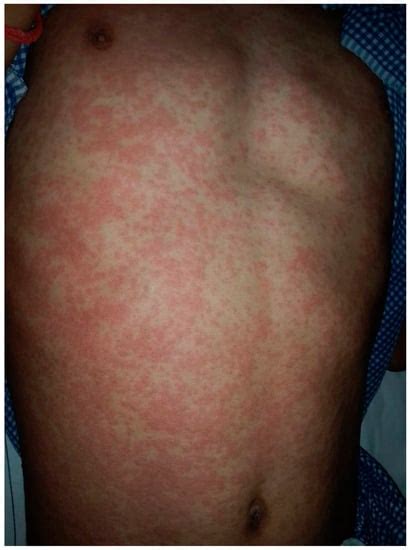 Drug-Induced vs. Viral Maculopapular Exanthem—Resolving the Dilemma