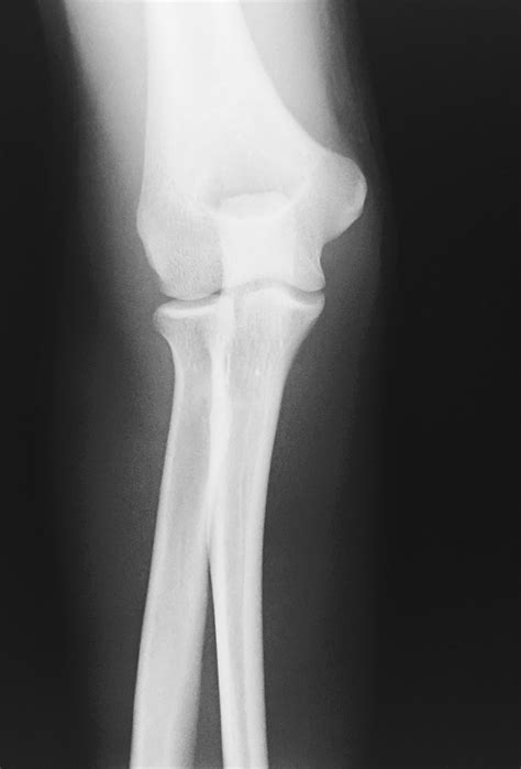 X Ray Elbow Joint Effusion at Pearl Murray blog