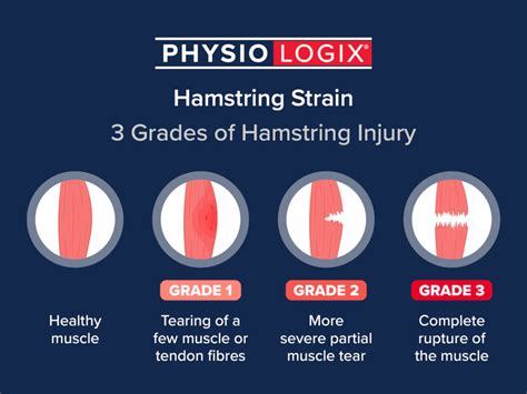 Pulled Hamstring 的图像结果
