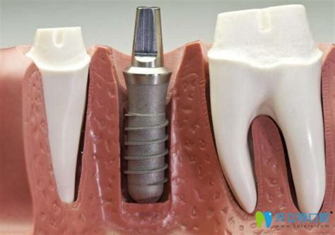即拔即种和种植牙的区别,其实是对的时机遇见对的牙齿条件 - 前沿技术 - 开立特口腔