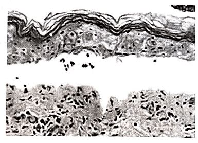 Steven Johnson syndrome (SJS) - Medical Science Optional Notes for UPSC ...