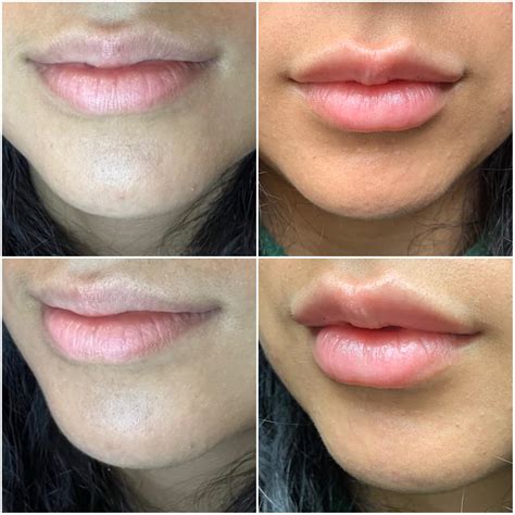 Lipinjecties Voor En Na Juvederm