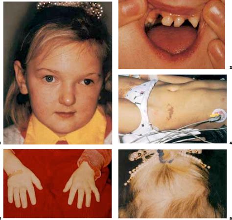 Bloch Sulzberger Syndrome